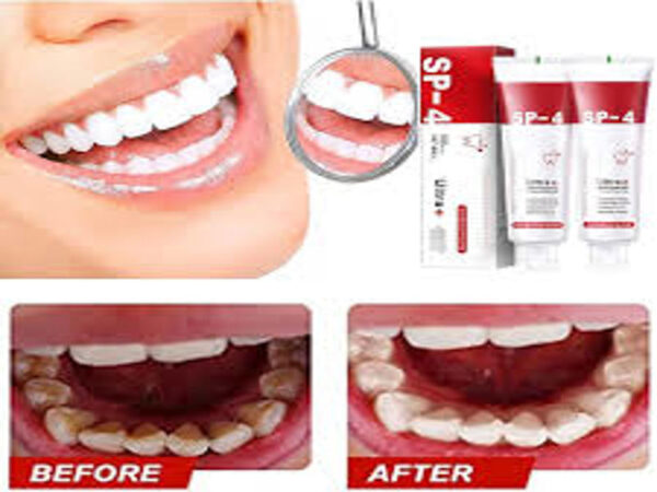 SP04-TEETH WHITENING - Image 2